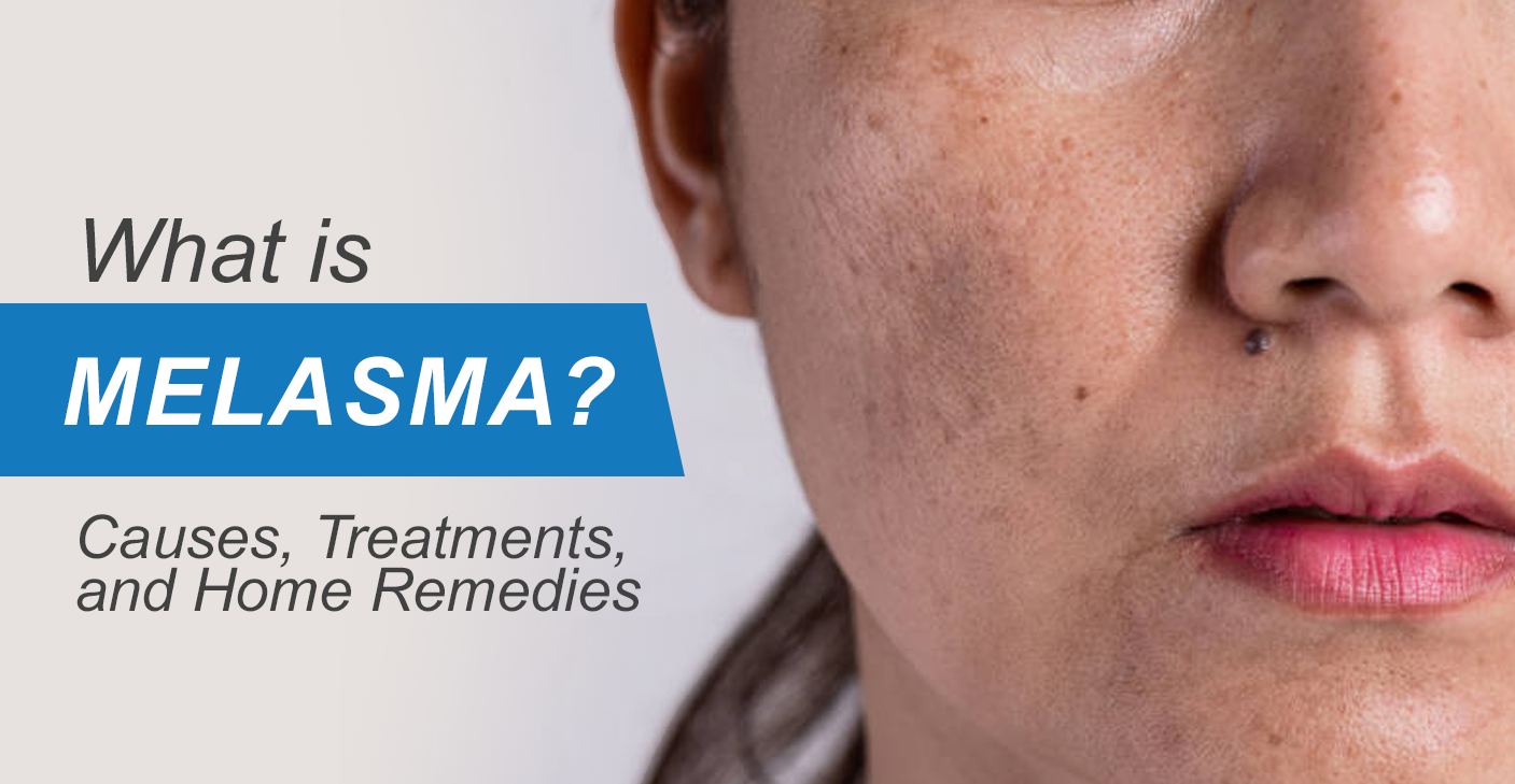 What is Melasma - Causes, Treatments, & Home Remedies
