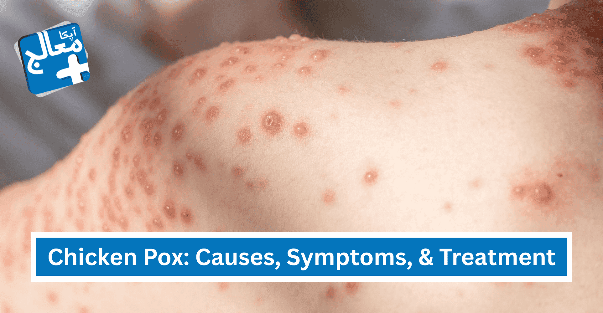Chicken Pox: Meaning In Urdu, Causes, Symptoms, & Best Treatment Options | Apka Muaalij Chicken Pox: Meaning In Urdu, Causes, Symptoms, & Best Treatment Options | Apka Muaalij