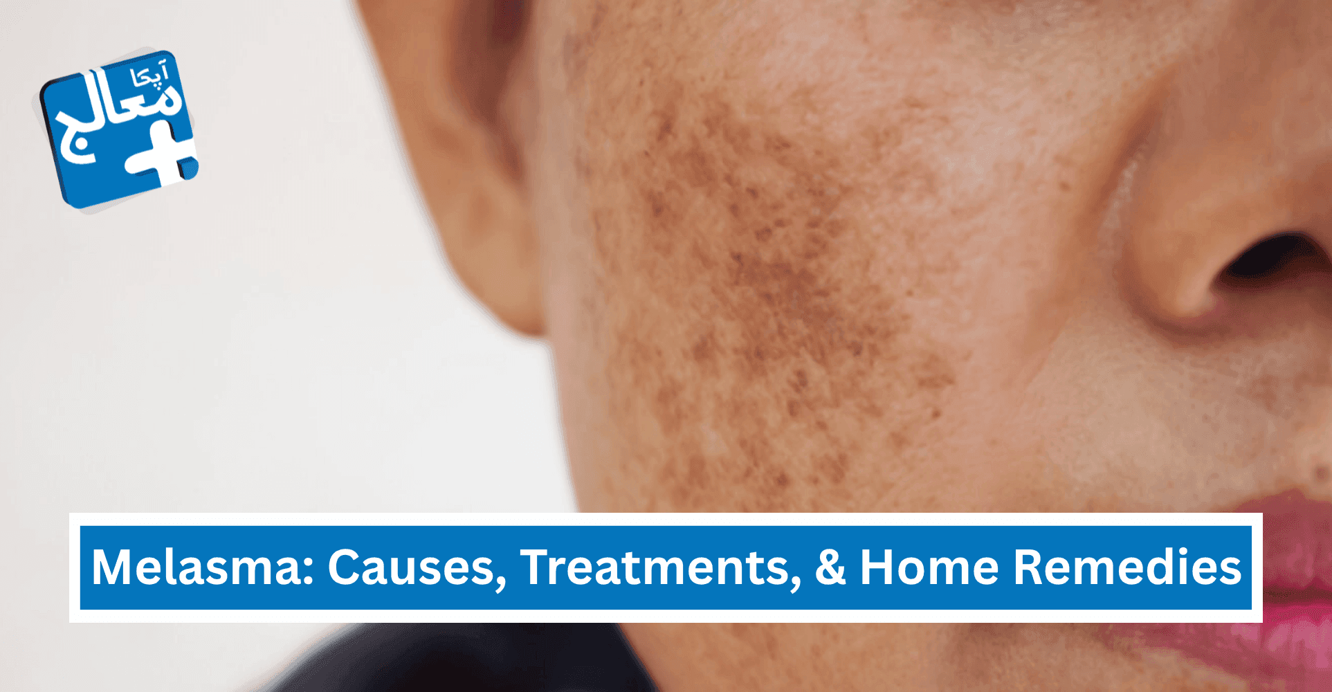 What is Melasma - Causes, Treatments, & Home Remedies | Apka Muaalij What is Melasma - Causes, Treatments, & Home Remedies | Apka Muaalij